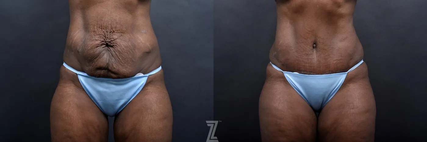 Austin Front Abdomen View 1 Year Post-OP Mommy Makeover in Austin, TX by Dr. Rocco Piazza - The Piazza Center