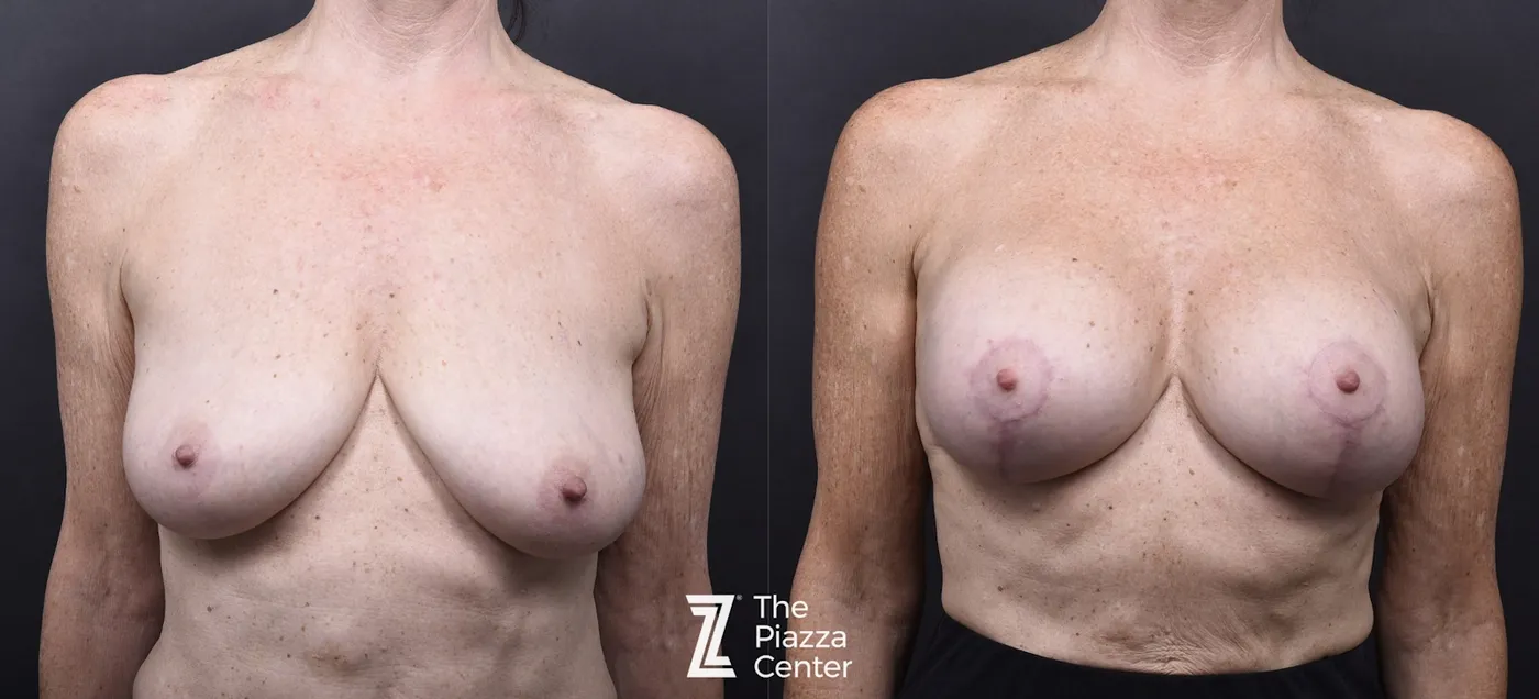 Austin Breast Augmentation With a Breast Lift Before & After Gallery - Patient 296286 - Image 1 - The Piazza Center