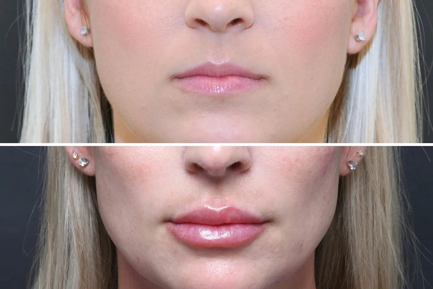 Austin Injectable Fillers Before & After Gallery - Patient 404245 - Image 3 - The Piazza Center
