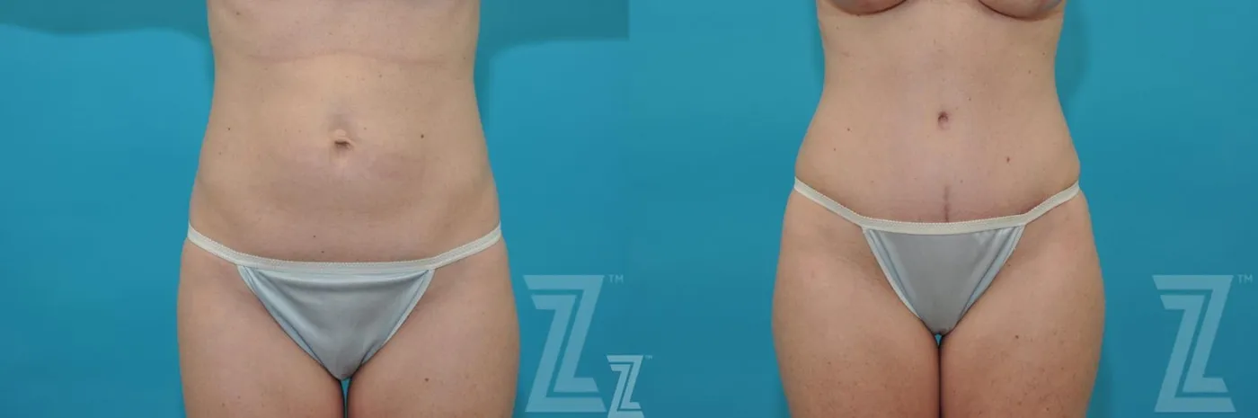 Austin Frontal abdominal view before & after images of 35 year old woman mommy make over - Dr. Rocco Piazza Austin TX - The Piazza Center