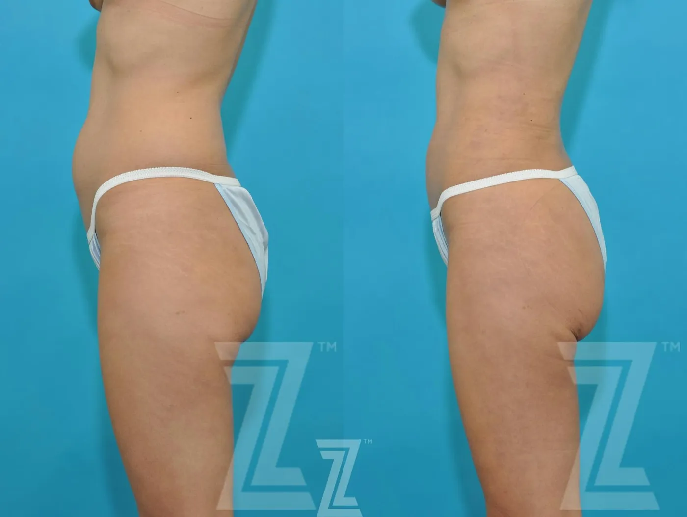 Austin Liposuction Before & After Gallery - Patient 132893822 - Image 2 - The Piazza Center