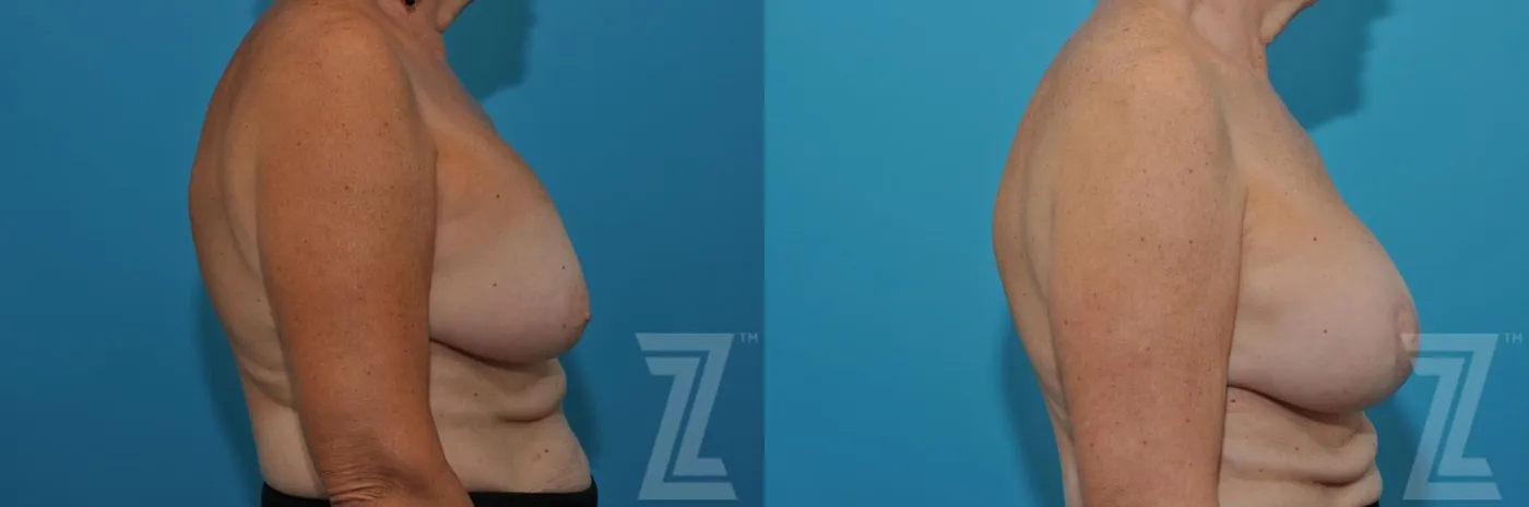 Austin Breast Augmentation Revision Before & After Gallery - Patient 132886586 - Image 5 - The Piazza Center