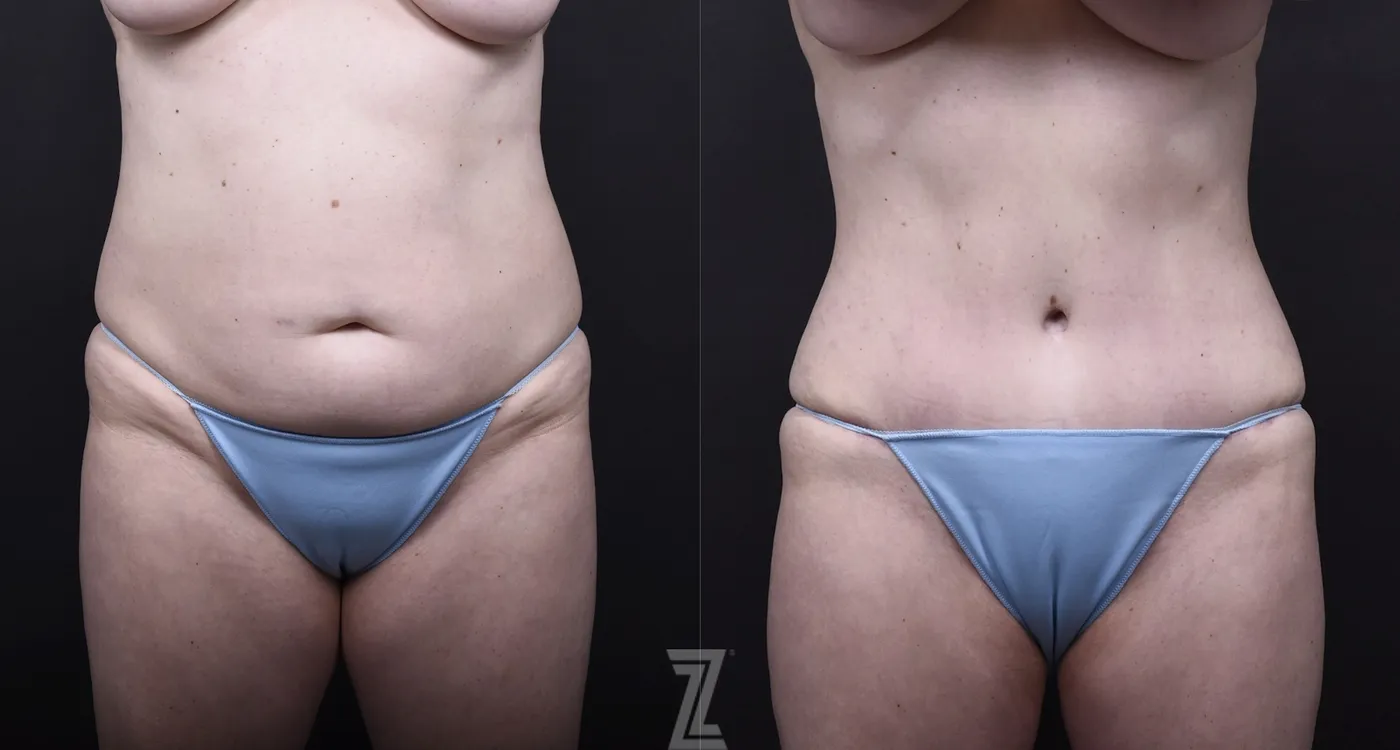 Austin Mommy Makeover Before & After Gallery - Patient 105405 - Image 1 - The Piazza Center