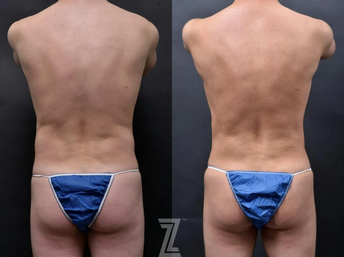 Austin Liposuction Before & After Gallery - Patient 132886947 - Image 3 - The Piazza Center