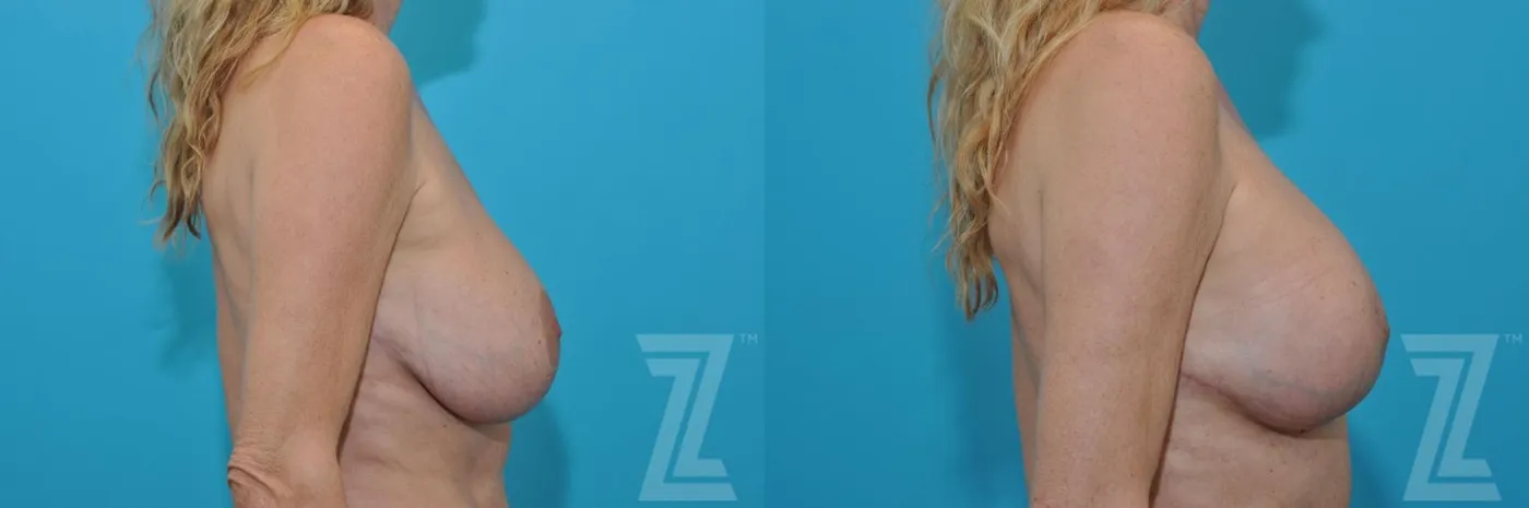 Austin Breast Augmentation Revision Before & After Gallery - Patient 132886579 - Image 5 - The Piazza Center