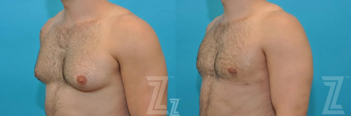 Austin Male Breast Reduction Before & After Gallery - Patient 132963603 - Image 2 - The Piazza Center