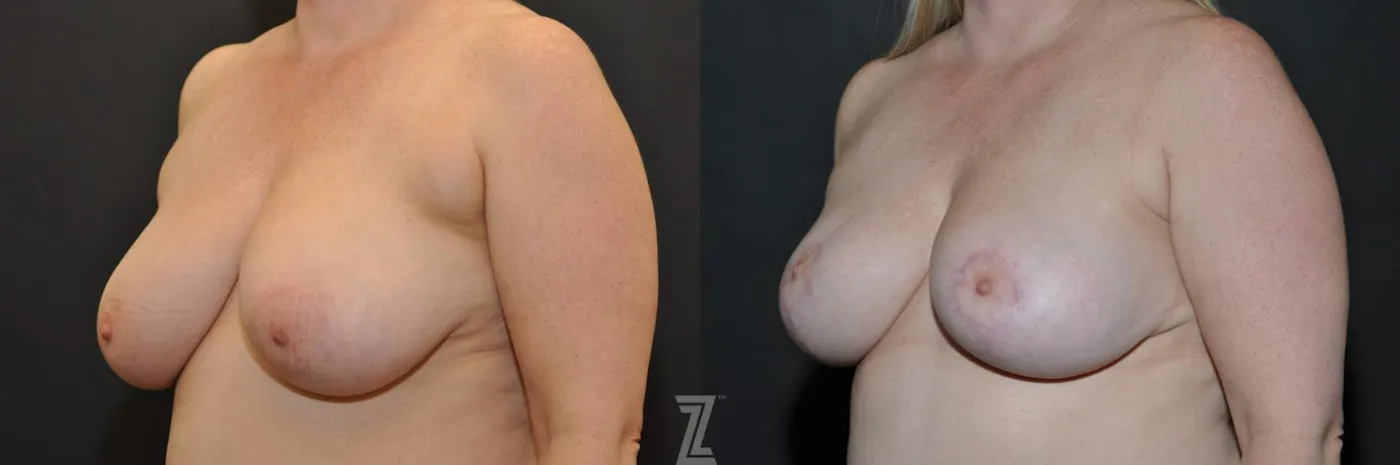 Austin Breast Reduction Before & After Gallery - Patient 132886615 - Image 2 - The Piazza Center