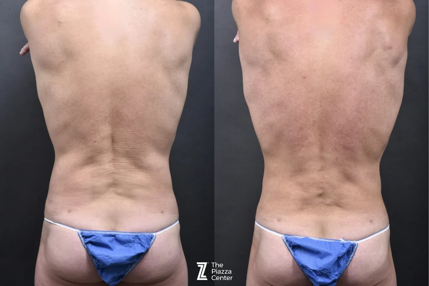 Austin Liposuction Before & After Gallery - Patient 355670 - Image 4 - The Piazza Center