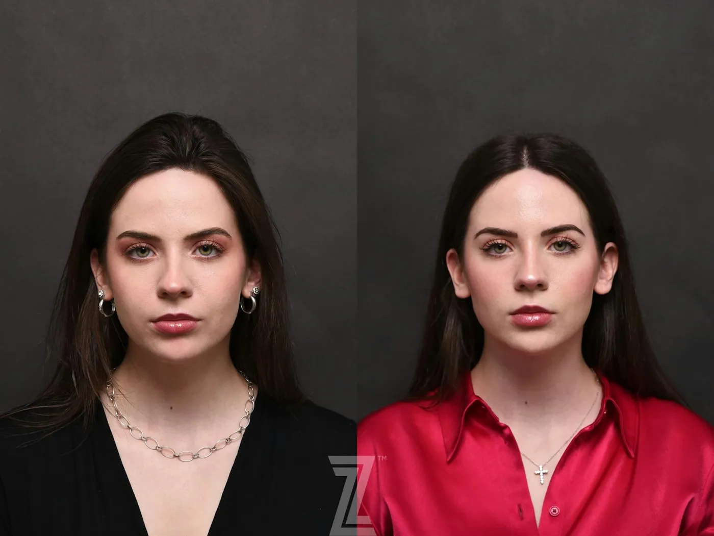 Austin Injectable Fillers Before & After Gallery - Patient 132963119 - Image 1 - The Piazza Center