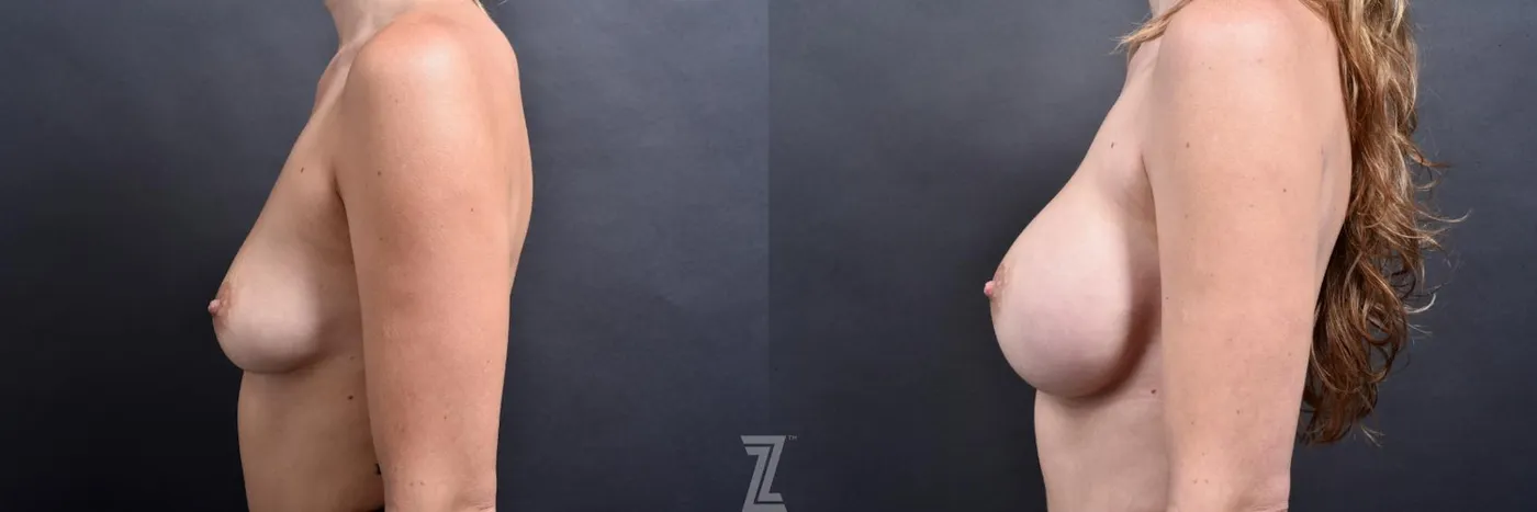 Austin Lateral View before and after 1 year post op 39 year old woman with Silicone Implants with Cohesive Silicone Gel - The Piazza Center