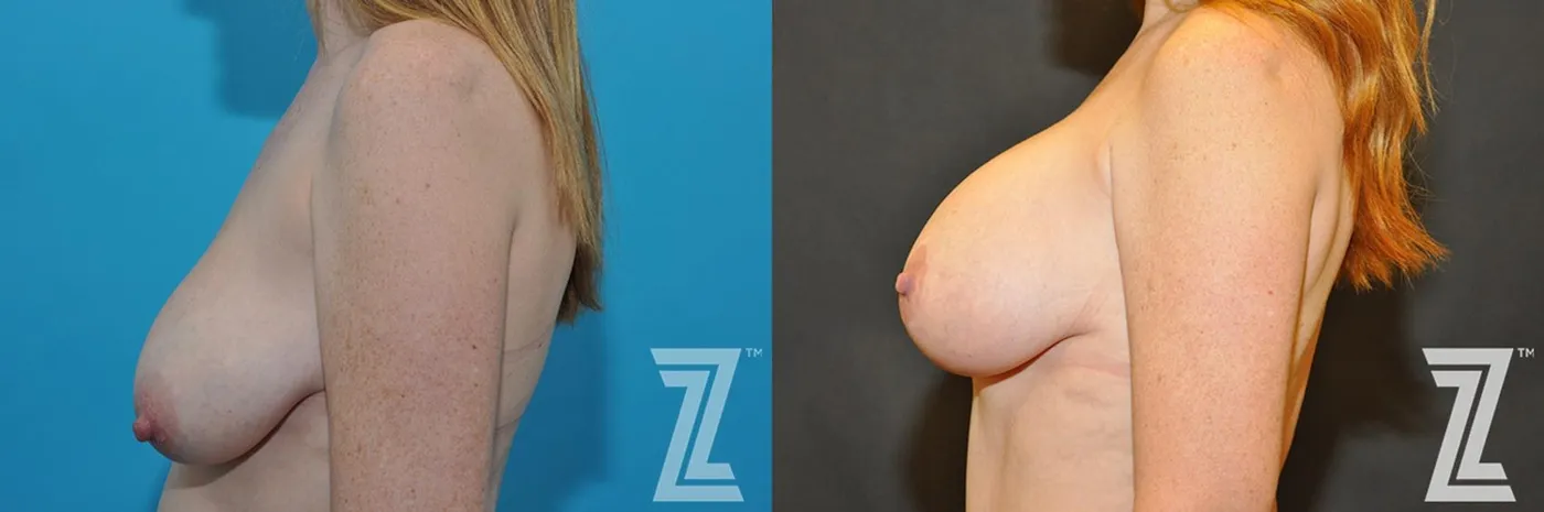 Austin Correction of Breast Asymmetry Before & After Gallery - Patient 132886778 - Image 3 - The Piazza Center