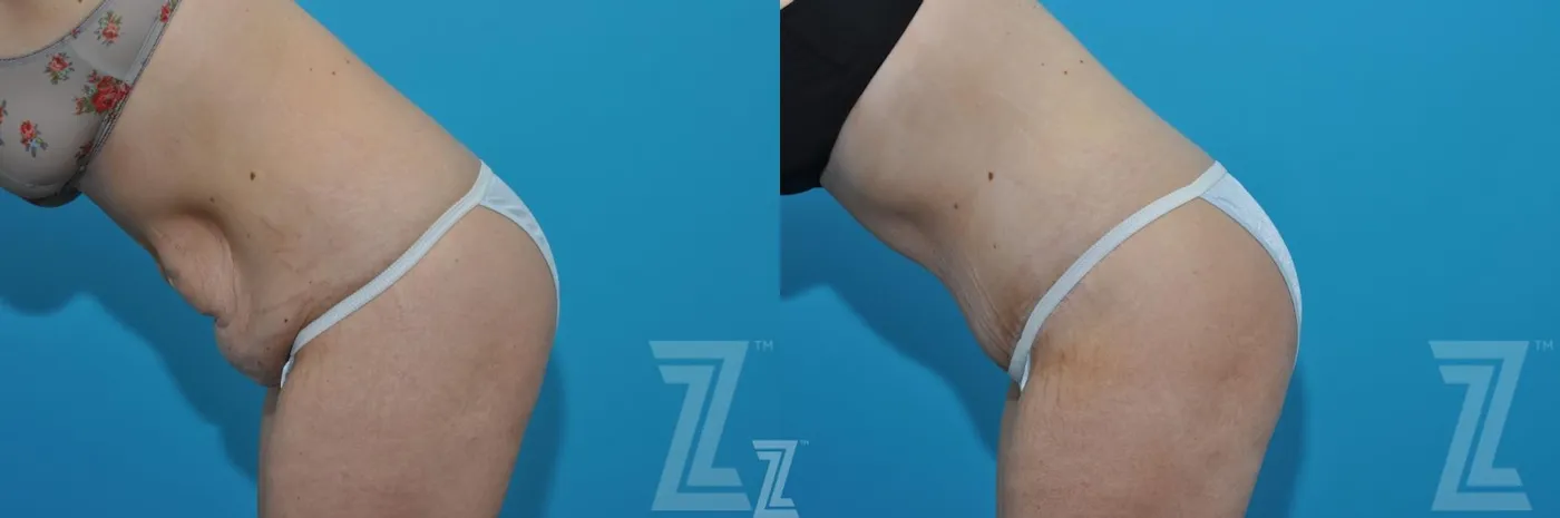Austin Liposuction Before & After Gallery - Patient 132903278 - Image 3 - The Piazza Center