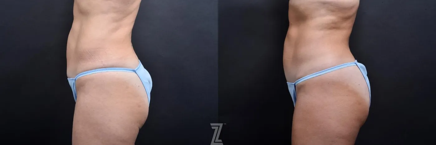 Austin Skin Pinch Before & After Gallery - Patient 132886939 - Image 2 - The Piazza Center