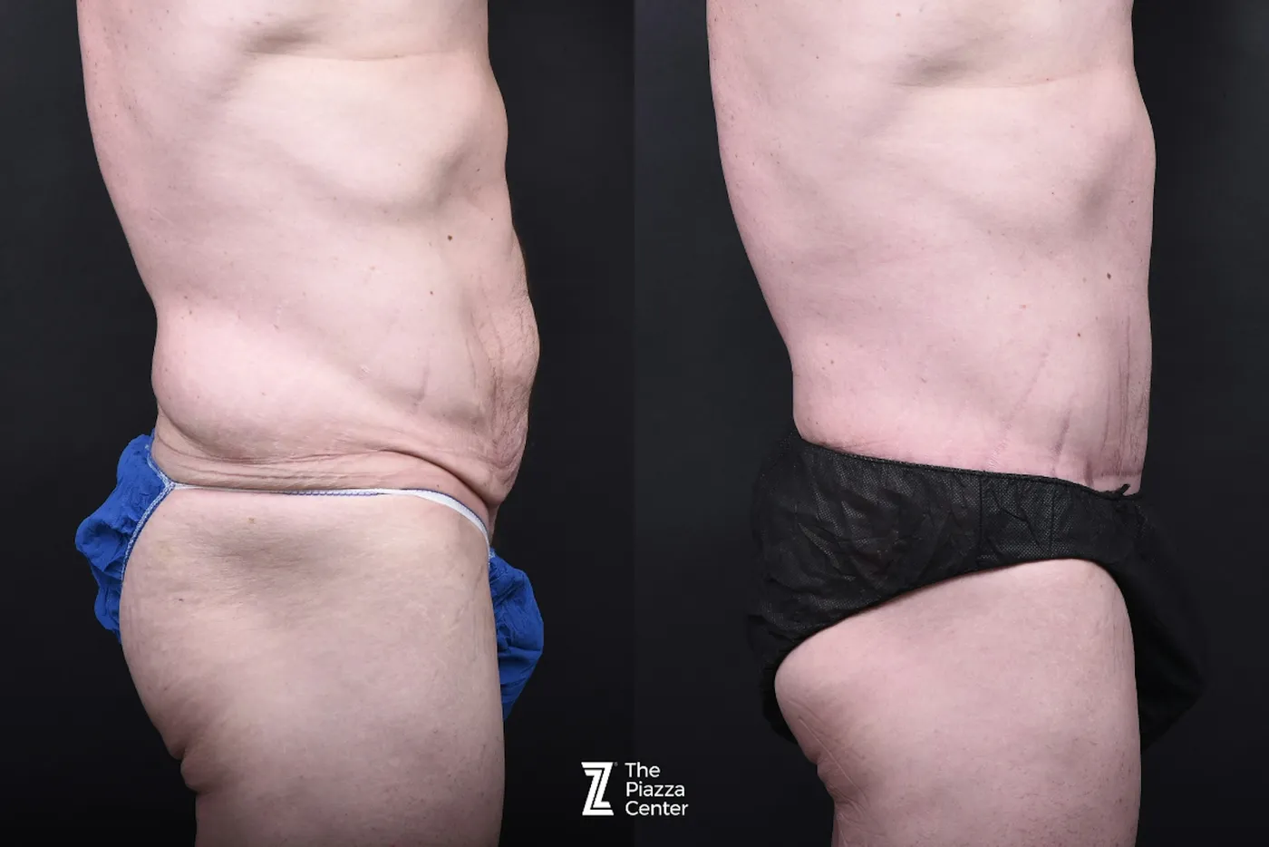 Austin Liposuction Before & After Gallery - Patient 313232 - Image 2 - The Piazza Center