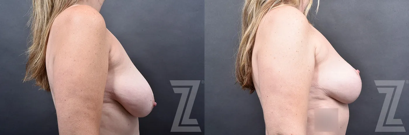 Austin Breast Lift Before & After Gallery - Patient 778016 - Image 3 - The Piazza Center