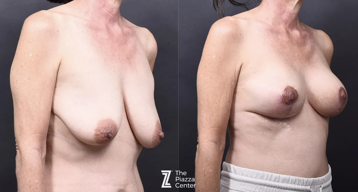 Austin Breast Augmentation With a Breast Lift - The Piazza Center