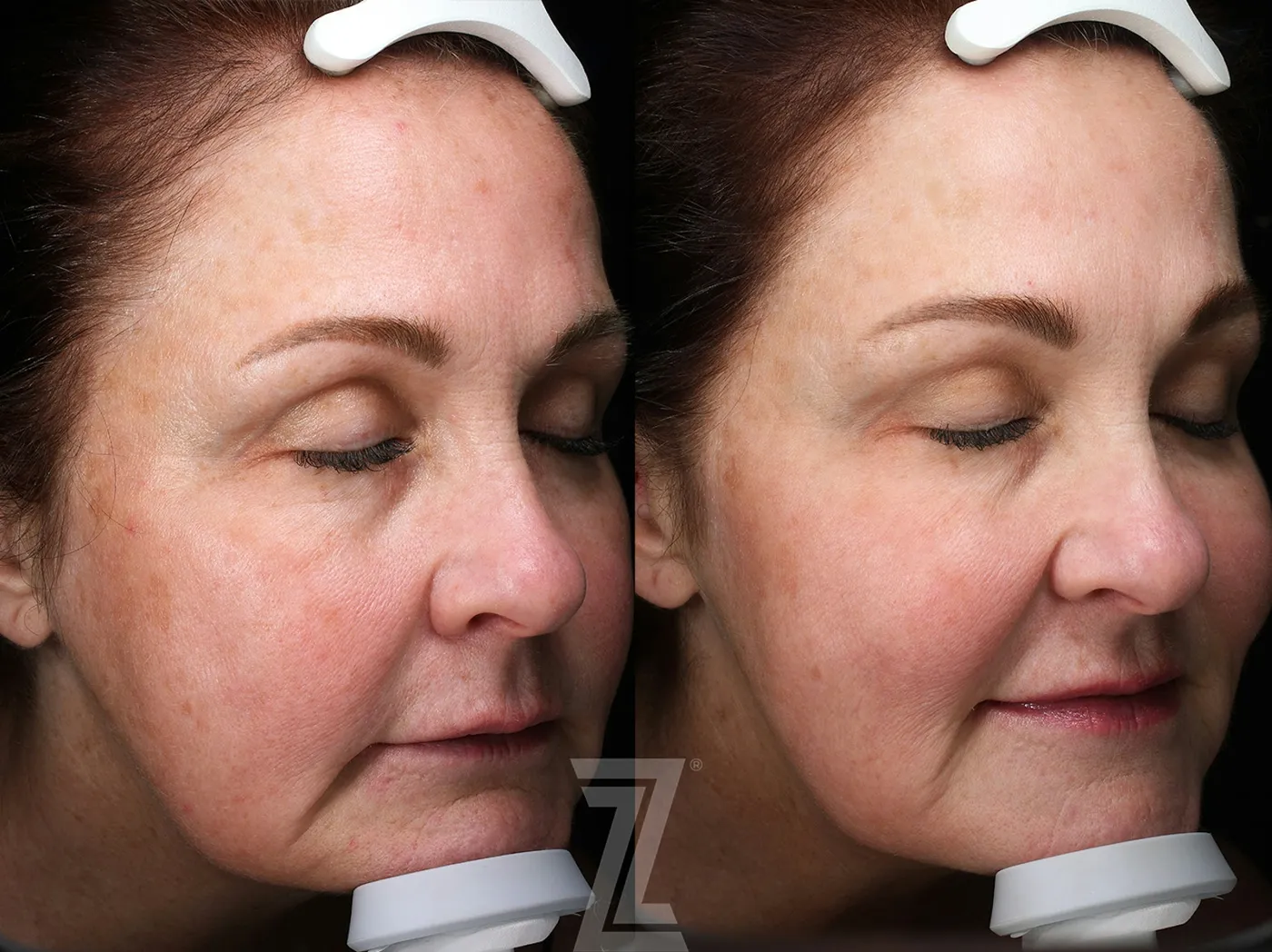 Austin HALO Before & After Gallery - Patient 367769 - Image 2 - The Piazza Center