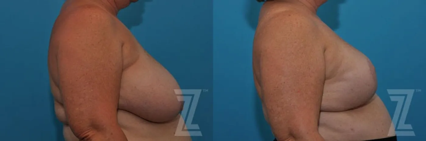 Austin Breast Reduction Before & After Gallery - Patient 132886617 - Image 5 - The Piazza Center