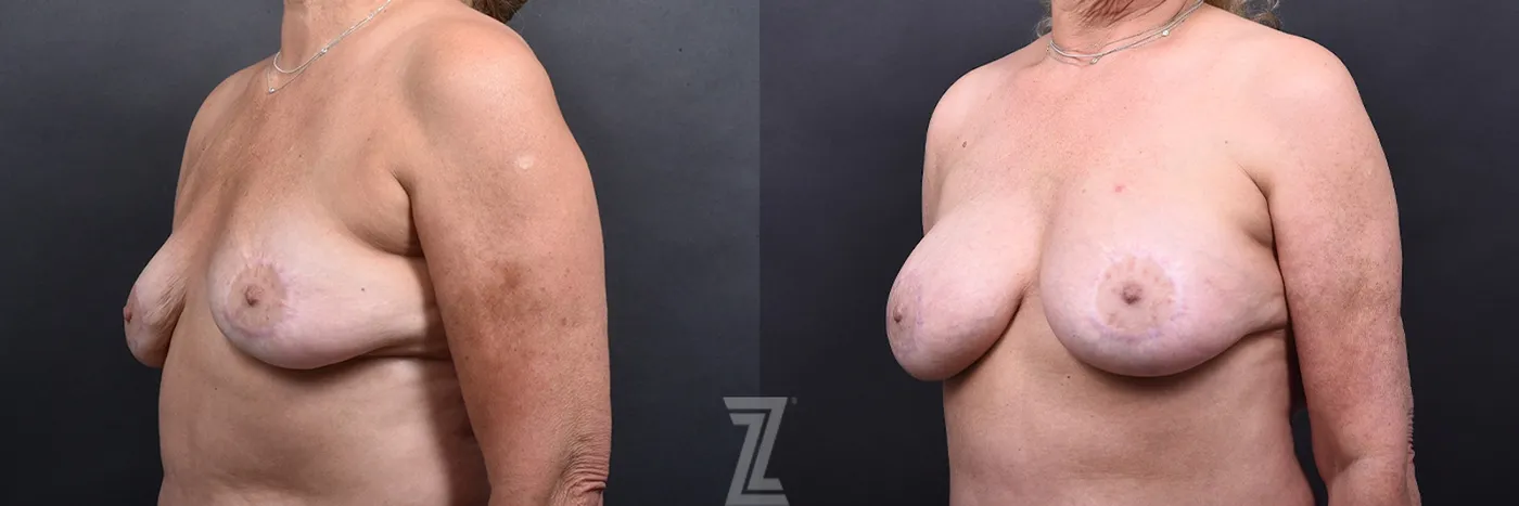 Austin Breast Lift Before & After Gallery - Patient 199955 - Image 4 - The Piazza Center