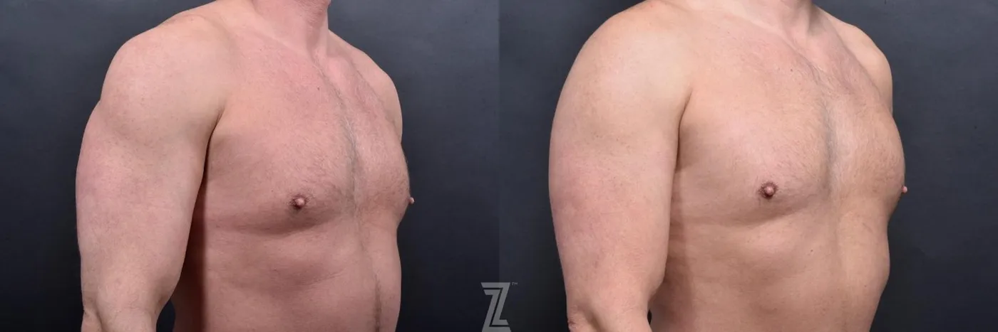 Austin Liposuction Before & After Gallery - Patient 132886943 - Image 6 - The Piazza Center