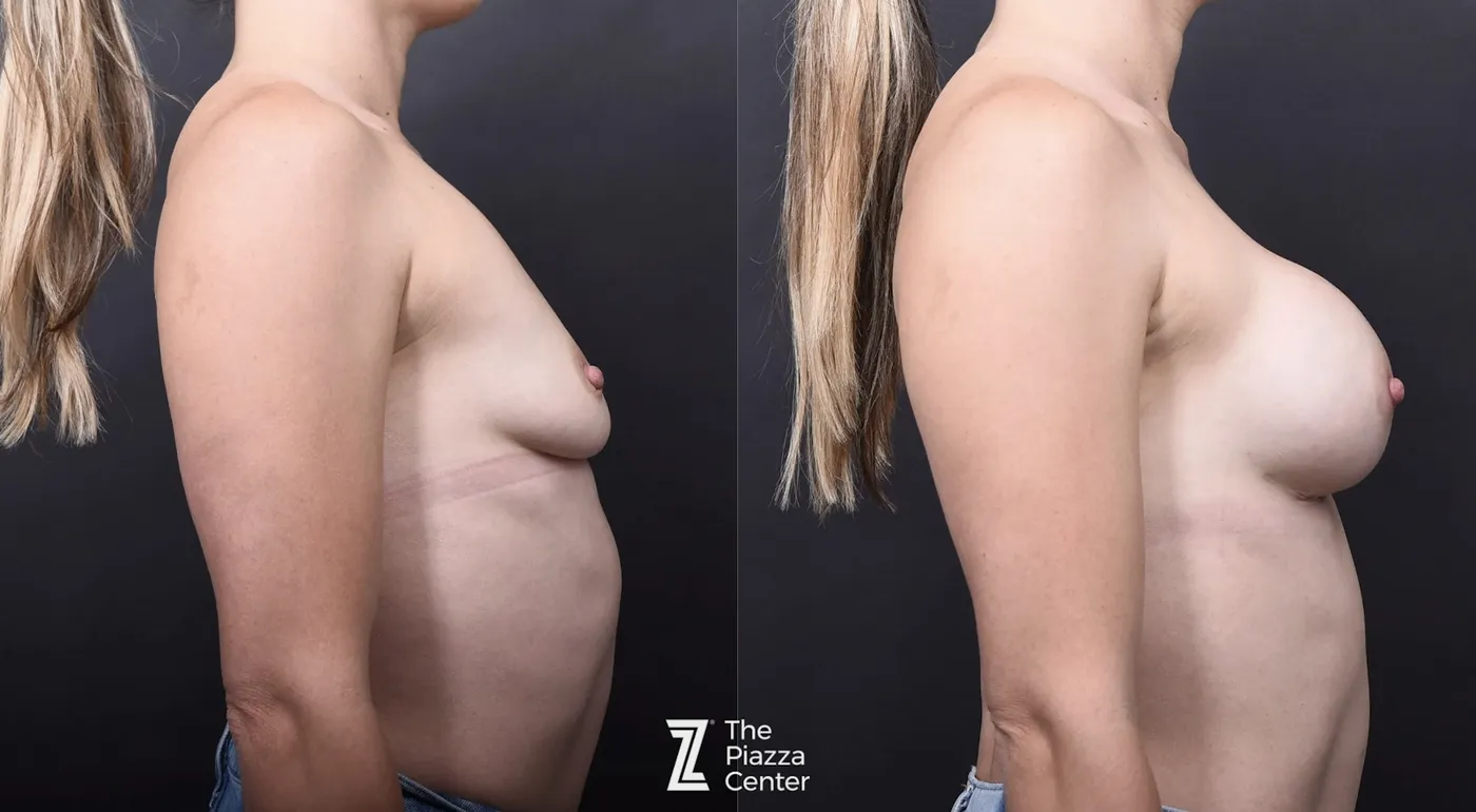 Austin Motiva Implants Before & After Gallery - Patient 222275 - Image 3 - The Piazza Center