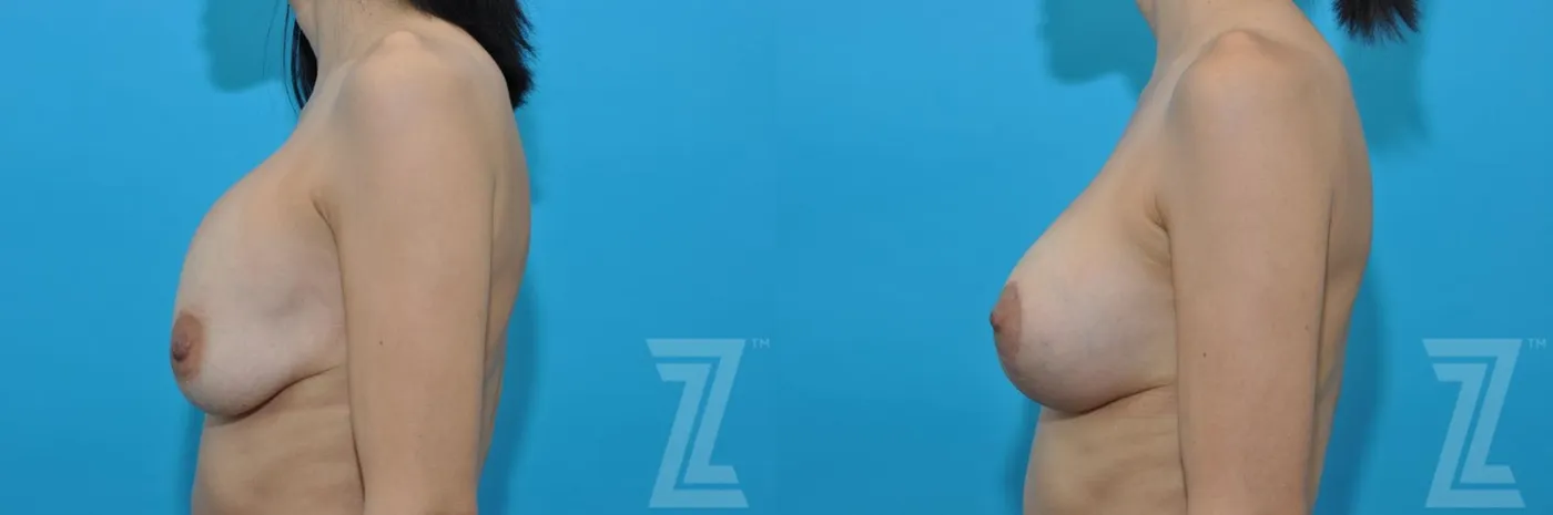 Austin Breast Augmentation Revision Before & After Gallery - Patient 132886578 - Image 2 - The Piazza Center