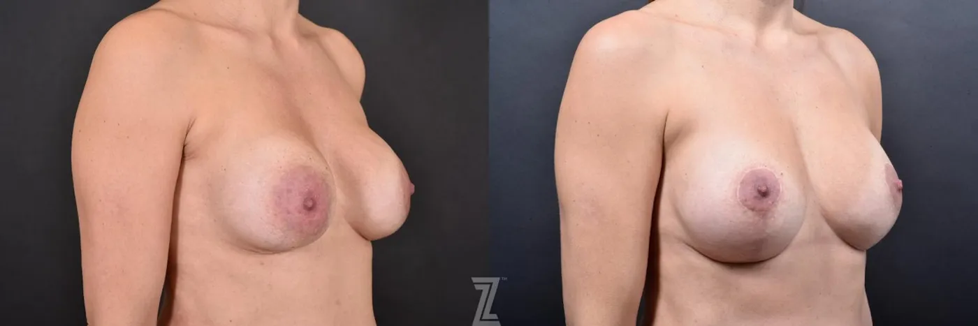 Austin Breast Augmentation Revision Before & After Gallery - Patient 132886593 - Image 4 - The Piazza Center