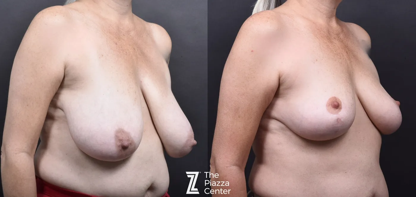 Austin Breast Lift Before & After Gallery - Patient 342651 - Image 2 - The Piazza Center