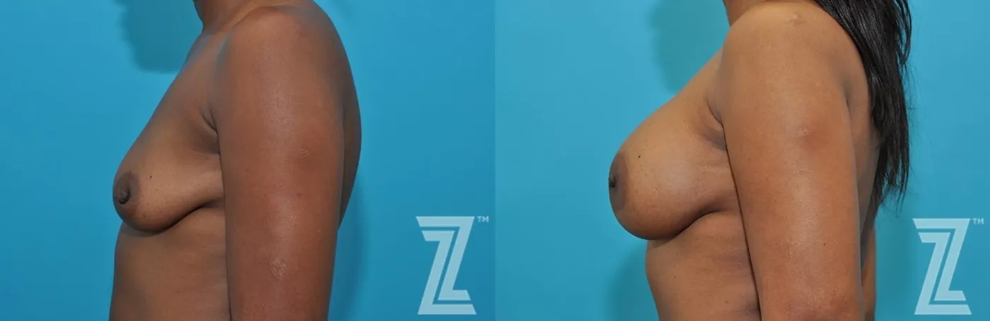 Austin Lateral breast view of 43-year-old mother of two mommy maker over - Dr. Rocco Piazza - The Piazza Center