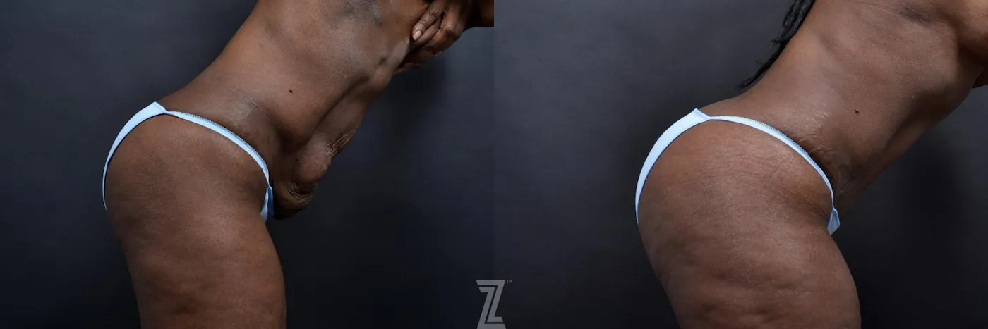 Austin 1 Year Post-OP Mommy Makeover in Austin, TX by Dr. Rocco Piazza - Lateral Abdomen View in Flexion - The Piazza Center