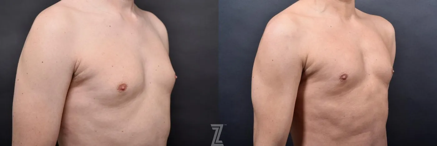 Austin Liposuction Before & After Gallery - Patient 132886947 - Image 7 - The Piazza Center