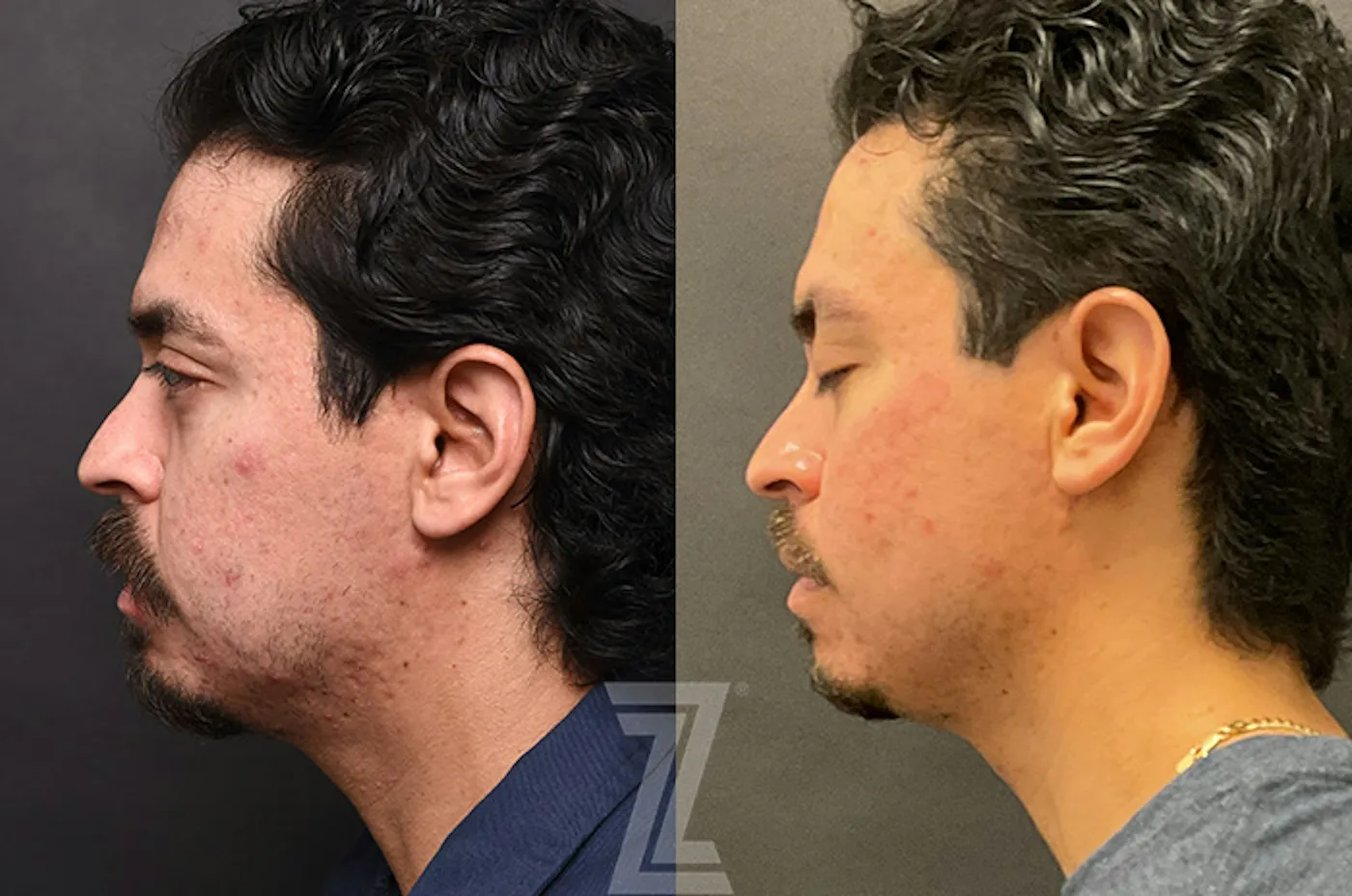 Austin Clear Skin Protocol Before & After Gallery - Patient 279974 - Image 5 - The Piazza Center