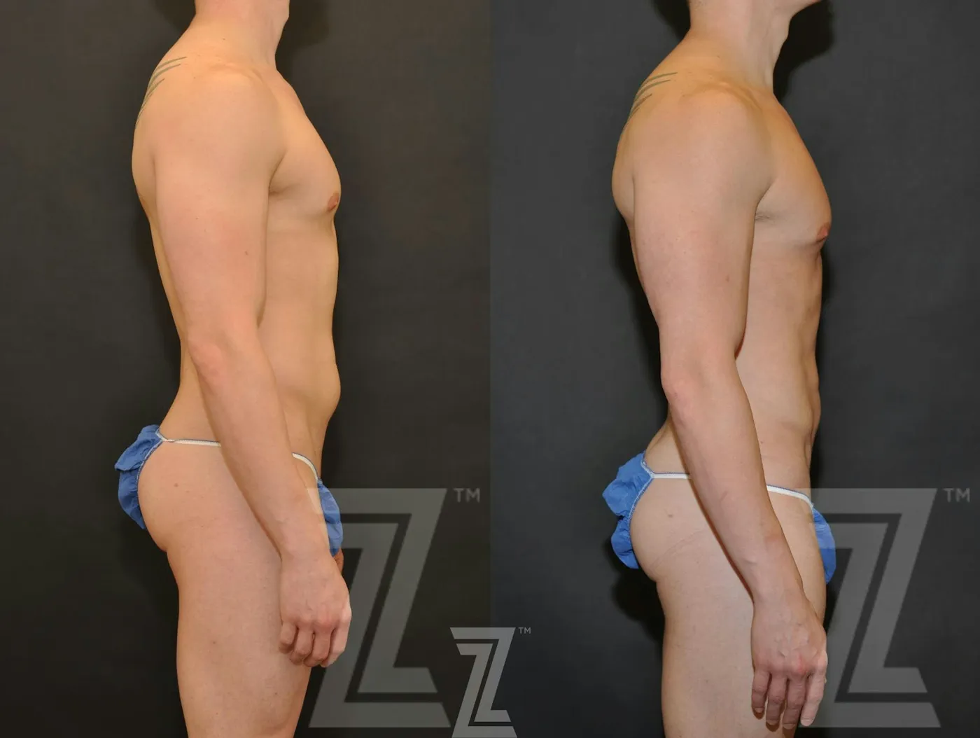 Austin Liposuction Before & After Gallery - Patient 132893823 - Image 5 - The Piazza Center