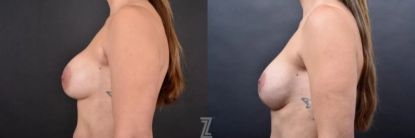 Austin Breast Augmentation Revision Before & After Gallery - Patient 132886593 - Image 3 - The Piazza Center