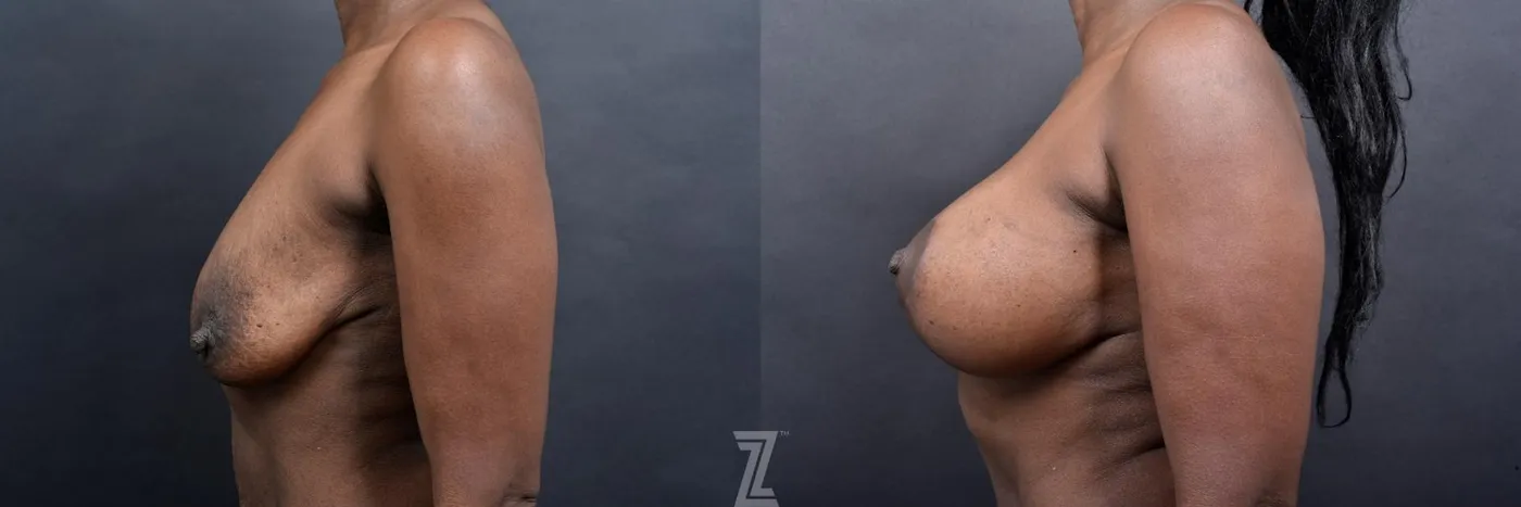 Austin Lateral View of Breasts 1 Year Post-OP Mommy Makeover in Austin, TX by Dr. Rocco Piazza - The Piazza Center