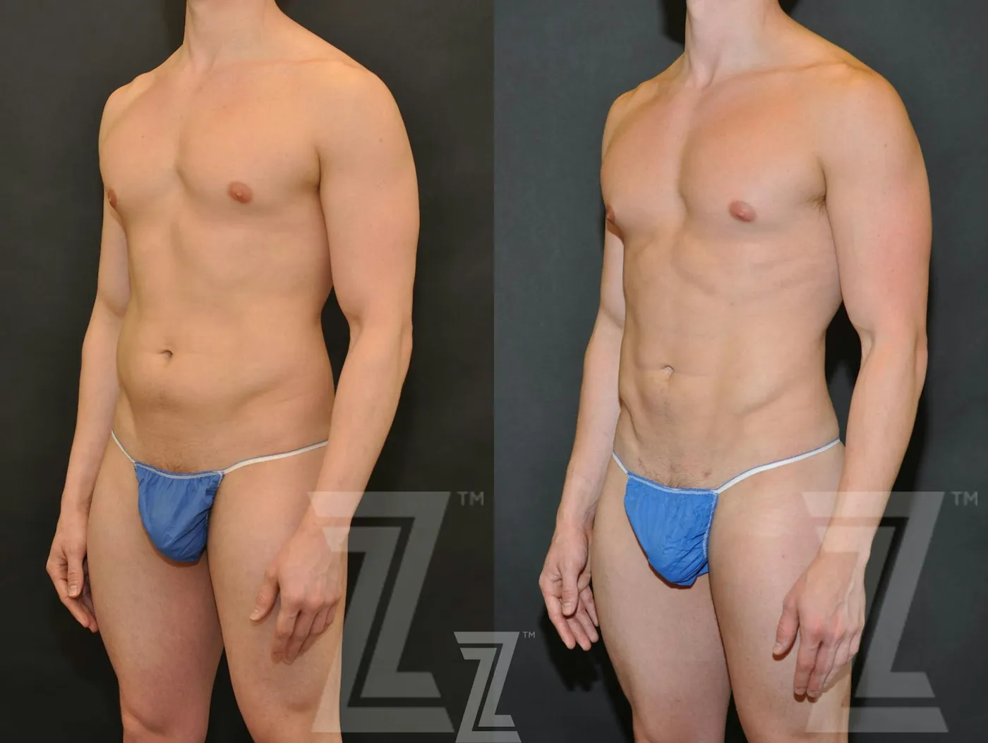 Austin Liposuction Before & After Gallery - Patient 132893823 - Image 2 - The Piazza Center