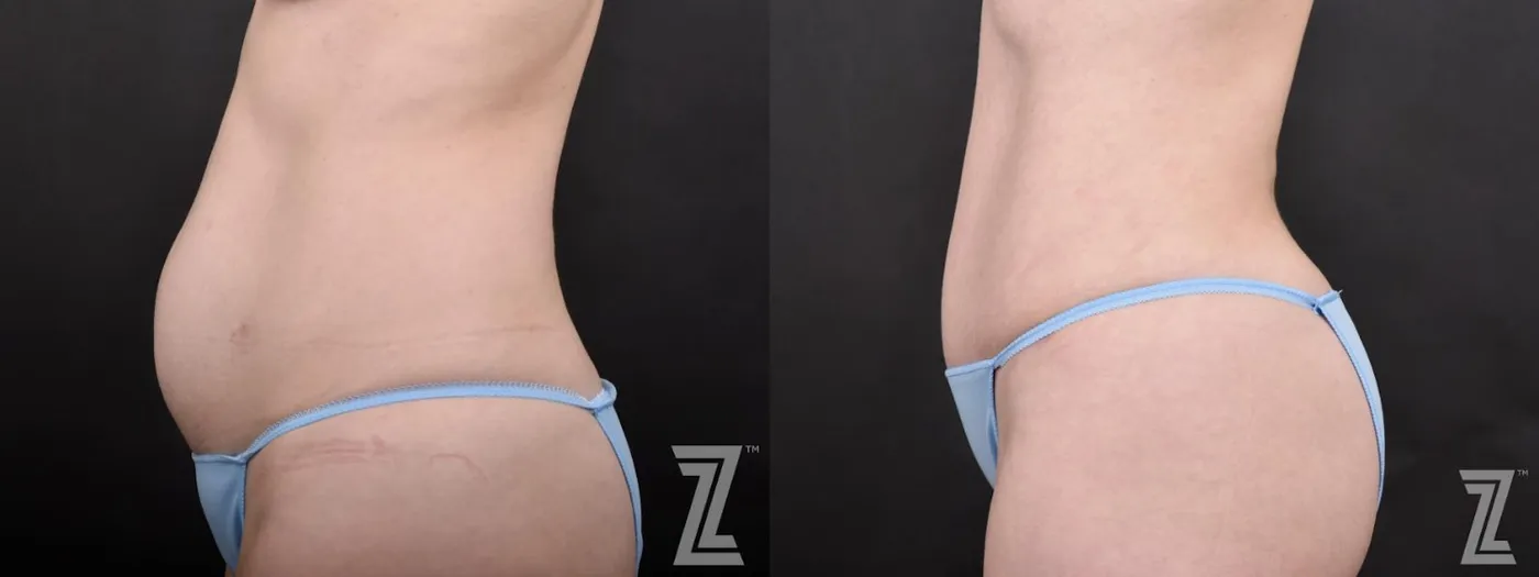 Austin Lateral View of Tummy from Mommy Makeover with Surgical Plan for a Breast Augmentation and a Contoured Waistline With an Abdominoplasty in Austin, TX by Dr. Rocco Piazza - Before & After - The Piazza Center