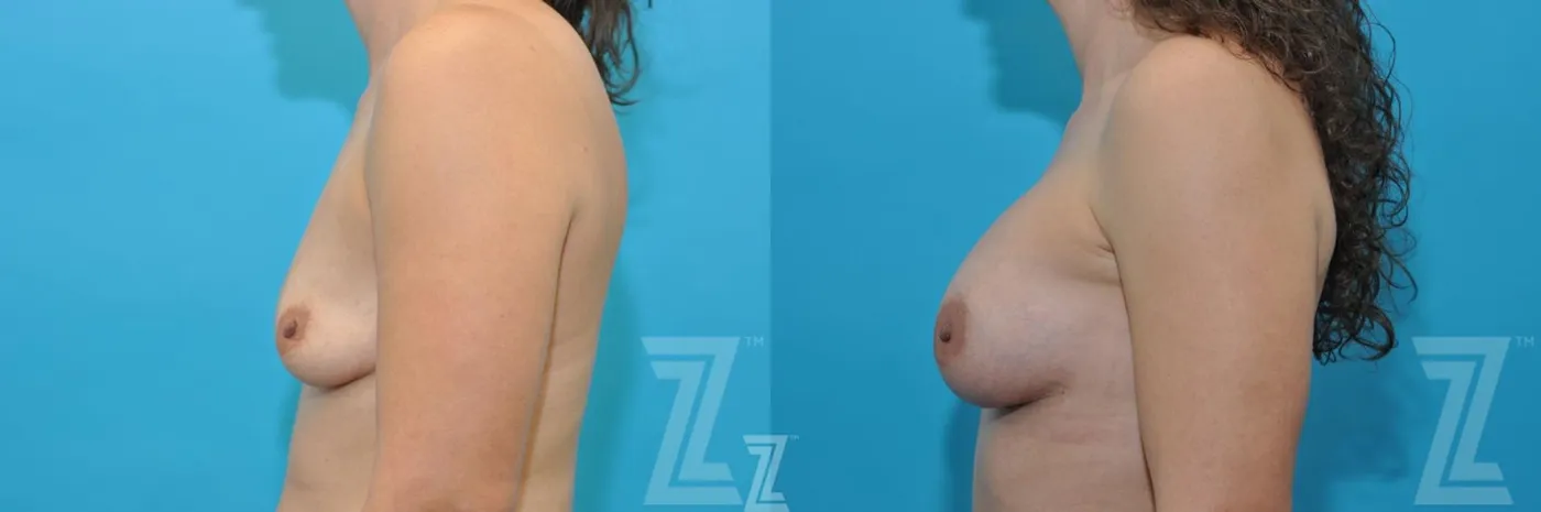 Austin Before & After images side breast view of 40-year-old mother of five mommy maker over - Dr. Rocco Piazza, Austin TX - The Piazza Center