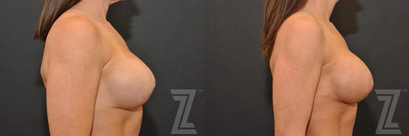 Austin Breast Augmentation Revision Before & After Gallery - Patient 132886594 - Image 5 - The Piazza Center