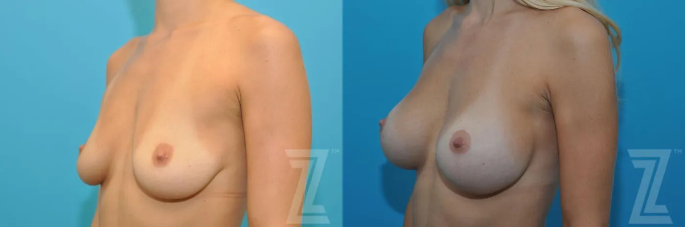 Austin Breast Augmentation With a Breast Lift Before & After Gallery - Patient 132791105 - Image 2 - The Piazza Center