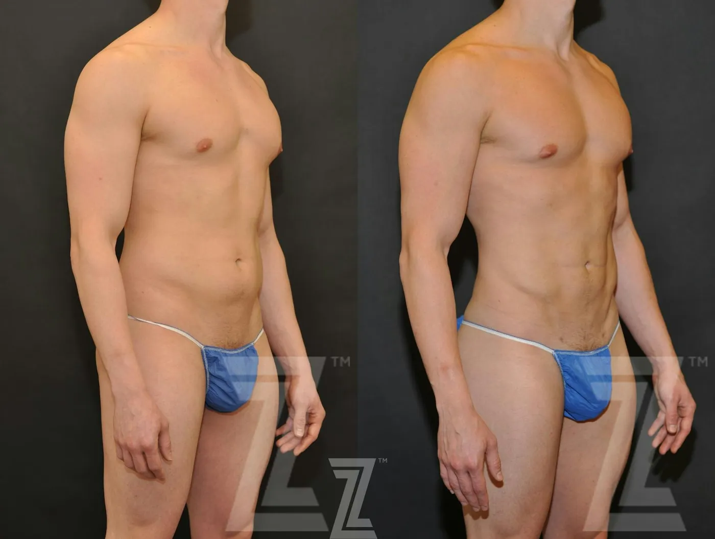 Austin Liposuction Before & After Gallery - Patient 132893823 - Image 4 - The Piazza Center