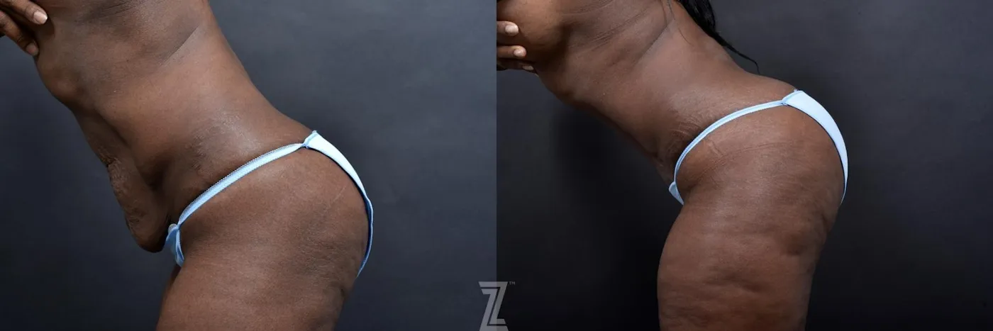 Austin Lateral Abdomen View in Flexion 1 Year Post-OP Mommy Makeover in Austin, TX by Dr. Rocco Piazza - The Piazza Center