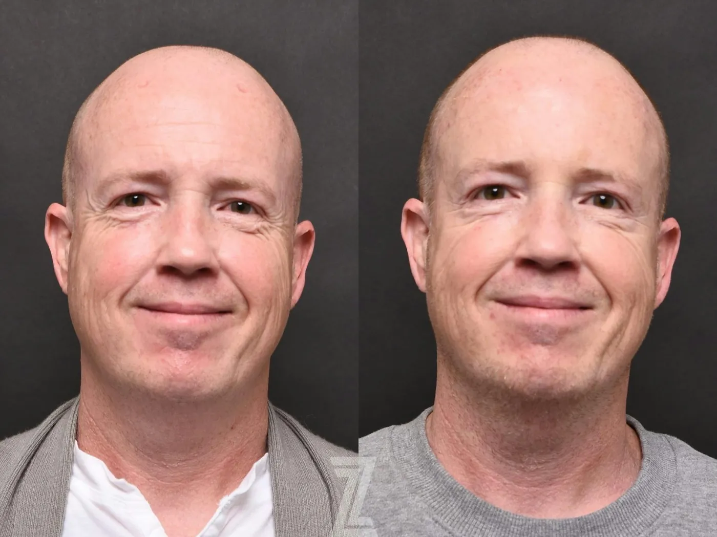Austin Wrinkle Relaxers Before & After Gallery - Patient 132906313 - Image 3 - The Piazza Center
