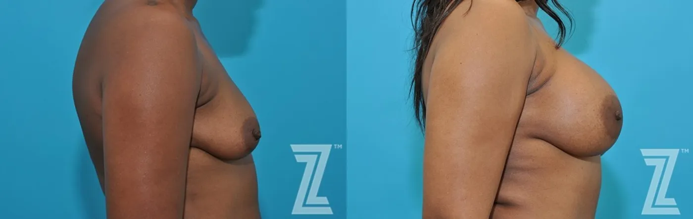 Austin Side breast view of 43-year-old mother of two mommy maker over - Dr. Rocco Piazza - The Piazza Center