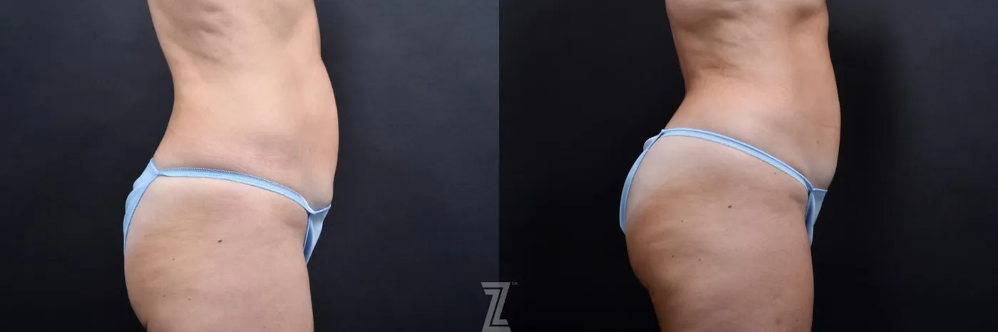 Austin Skin Pinch Before & After Gallery - Patient 132886939 - Image 4 - The Piazza Center