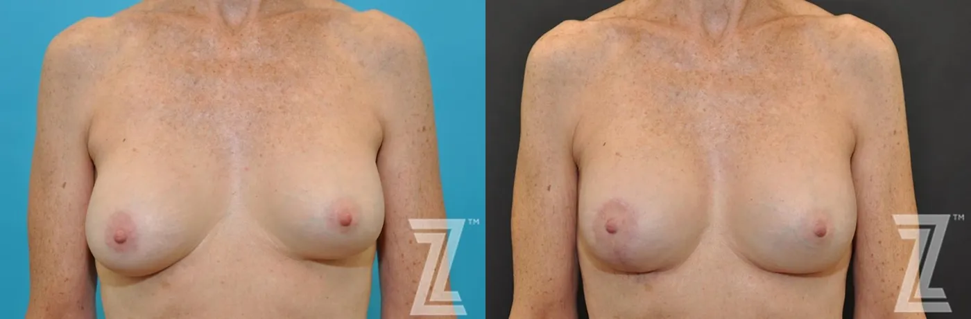 Austin Breast Augmentation Revision Before & After Gallery - Patient 132793347 - Image 1 - The Piazza Center