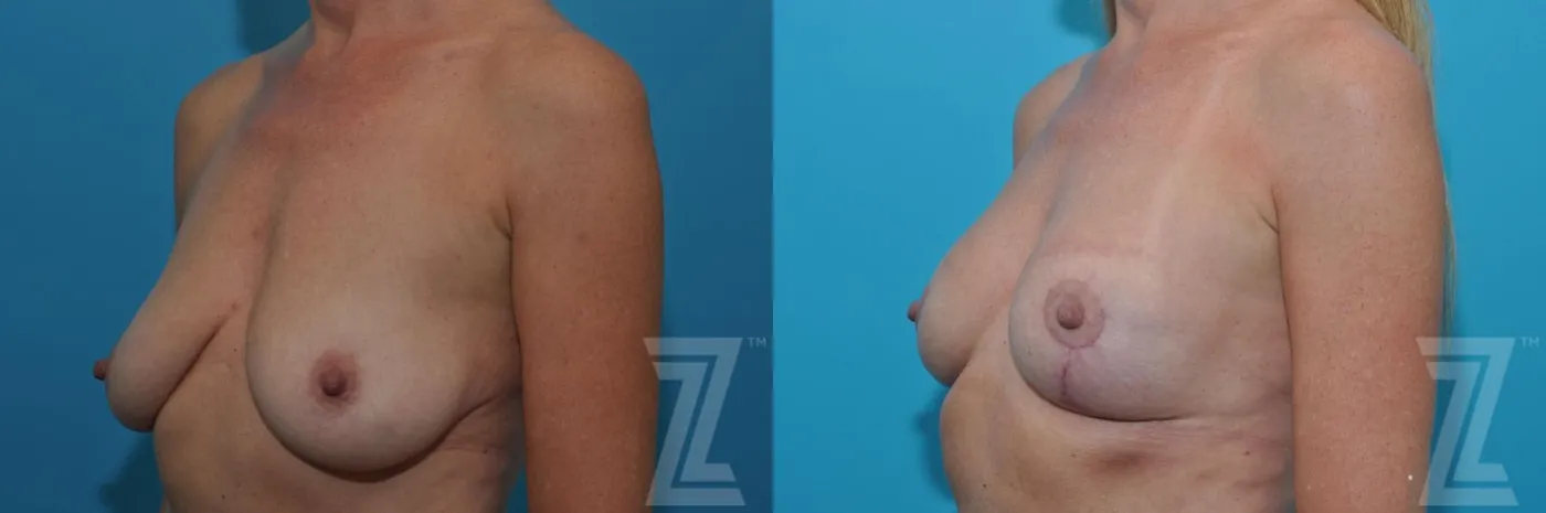 Austin Breast Lift Before & After Gallery - Patient 132791081 - Image 2 - The Piazza Center