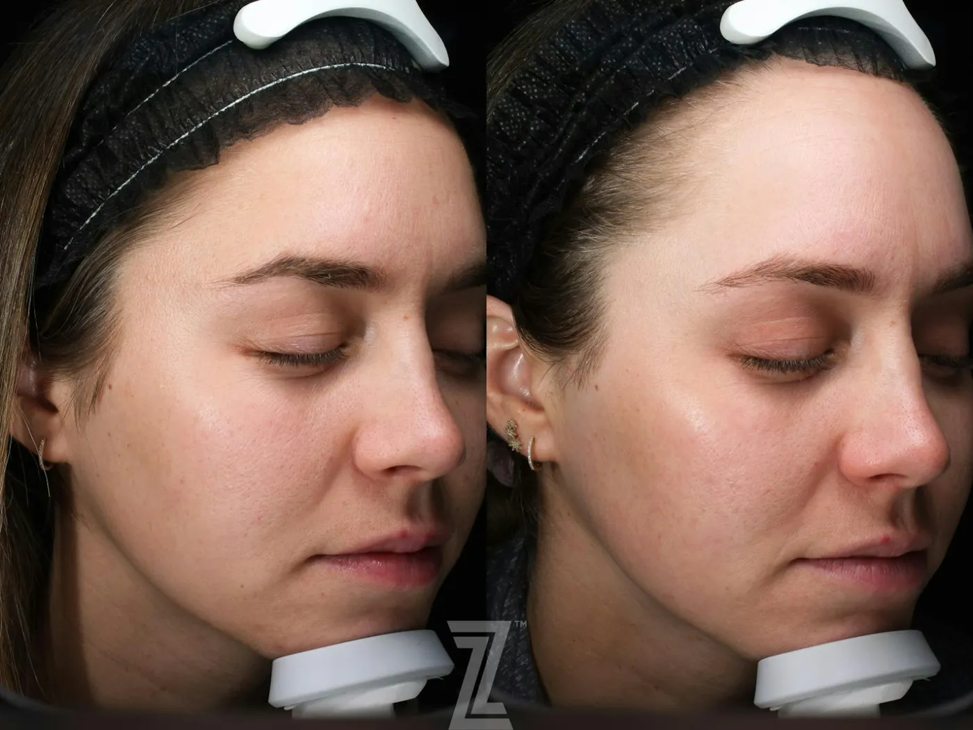 Austin SkinPen Microneedling Before & After Gallery - Patient 270635 - Image 3 - The Piazza Center