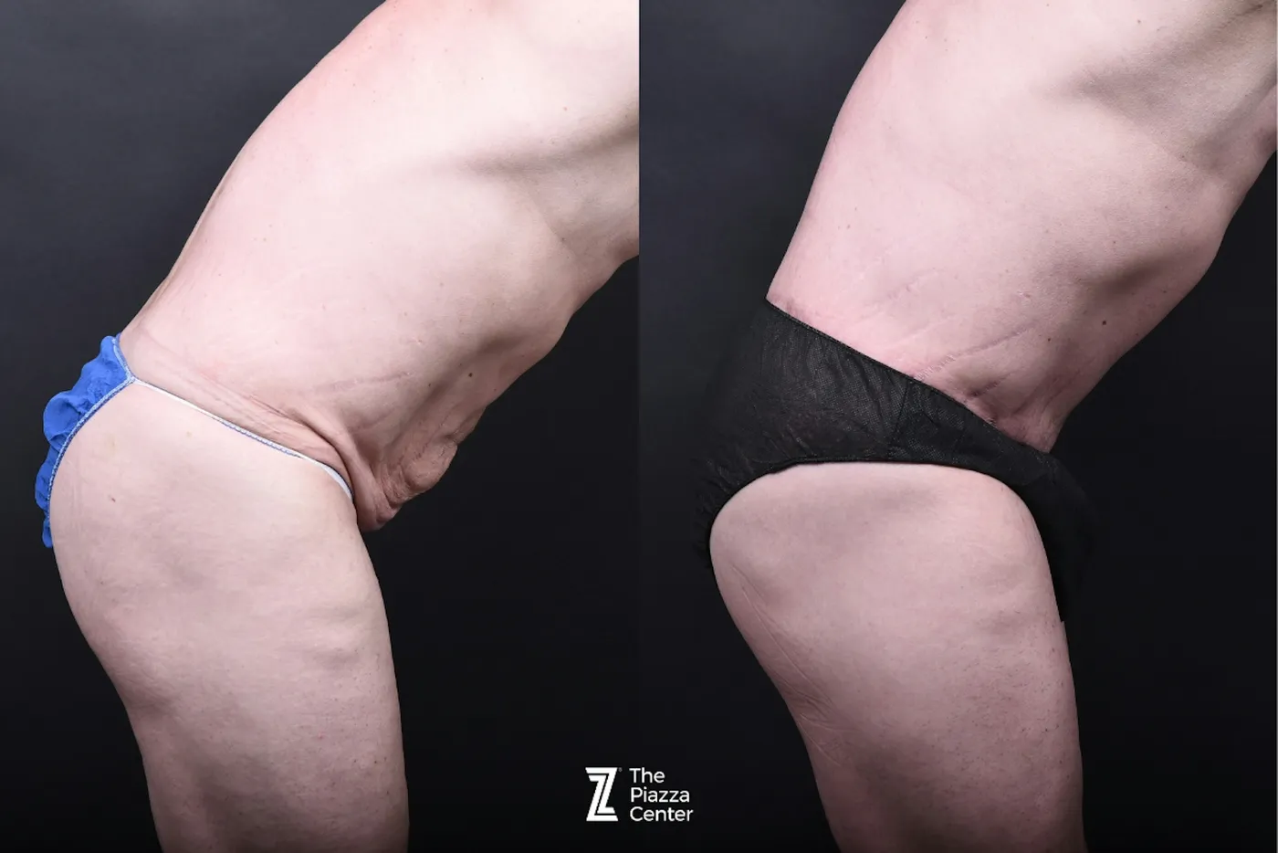 Austin Liposuction Before & After Gallery - Patient 313232 - Image 3 - The Piazza Center