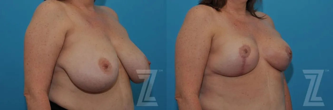 Austin Breast Reduction Before & After Gallery - Patient 132886747 - Image 4 - The Piazza Center